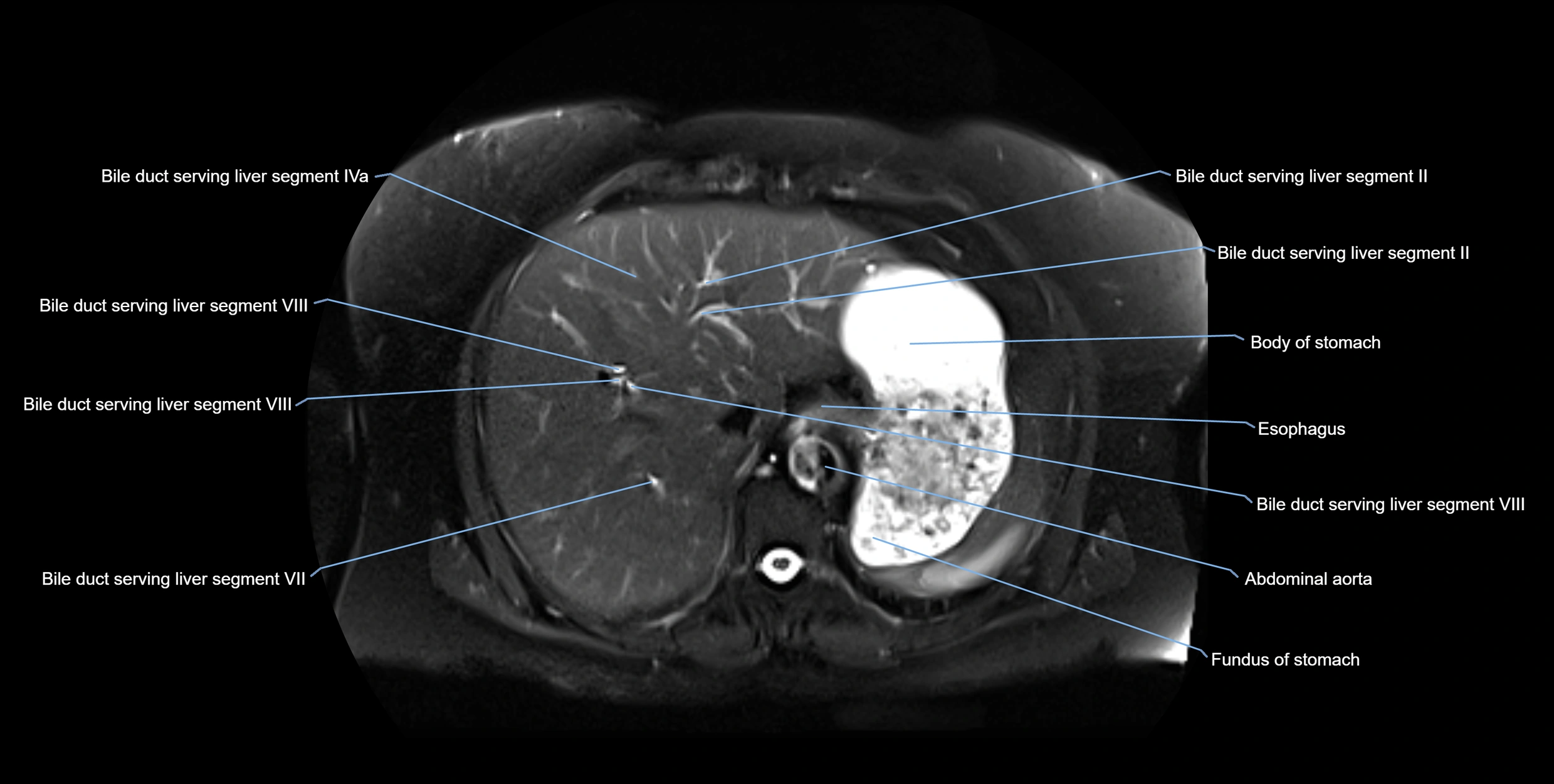 MRI MRCP axial cross sectional anatomy 3T radiology  image-img-10001-00011.webp